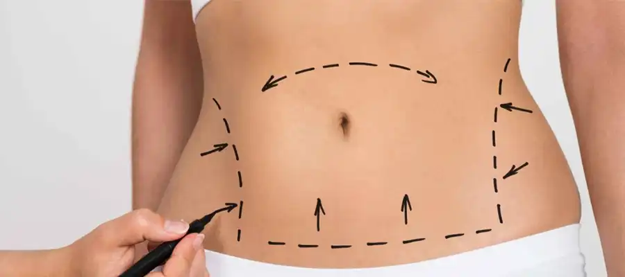 Tummy Tuck (Abdominoplasty)