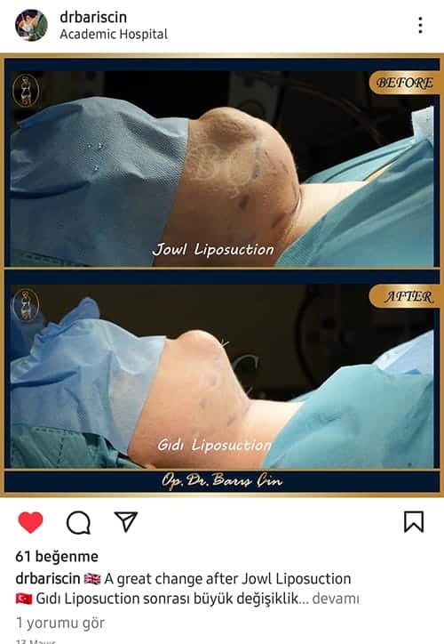 Jowl Liposuction 2