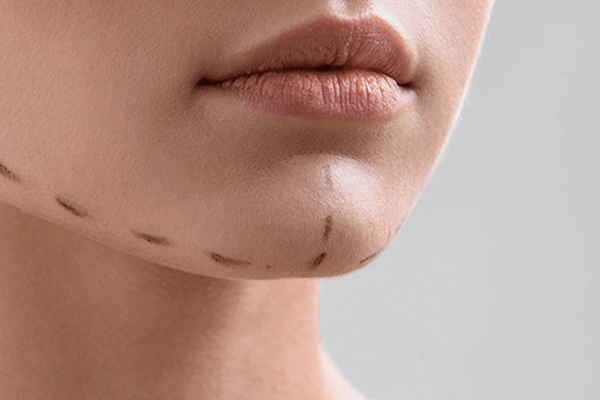 jawline-filler